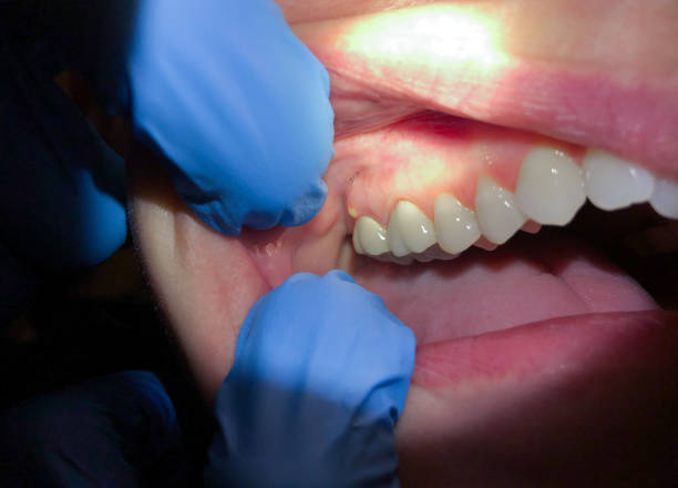 Best Knocked-Out Tooth Emergency  in New Carlisle, OH